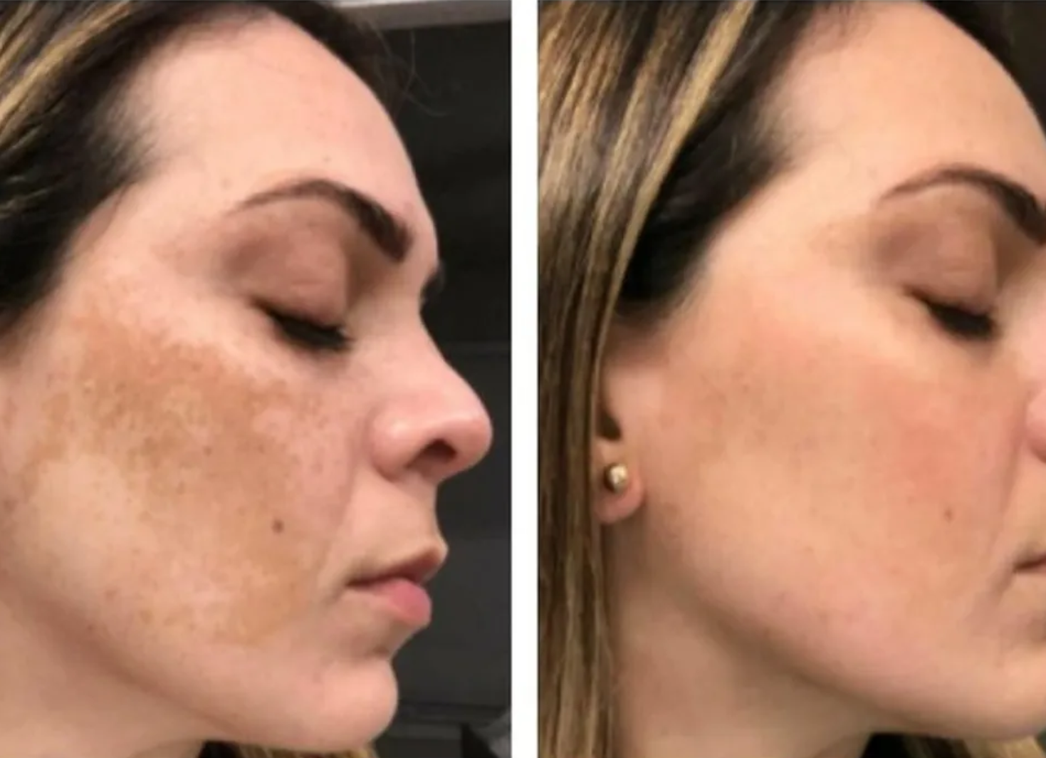 AdvaTX Laser before and after images